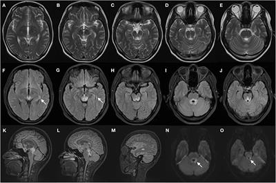 Classical Triad and Periventricular Lesions Do Not Necessarily Indicate Wernicke's Encephalopathy: A Case Report and Review of the Literature